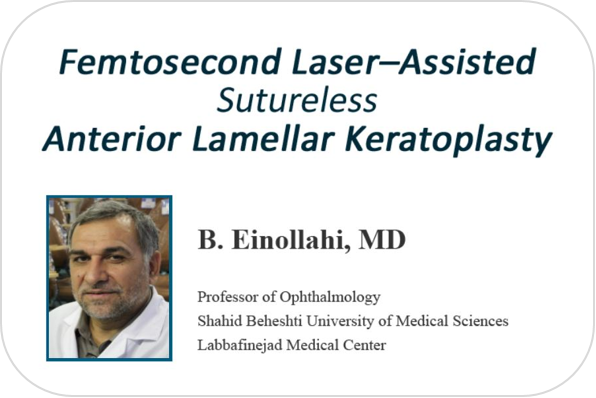 Femtosecond Laser-Assisted Suture less Anterior Lamellar Keratoplasty